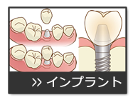 治療案内　インプラント