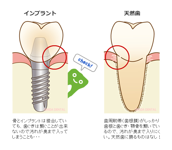 インプラントと天然歯の違い