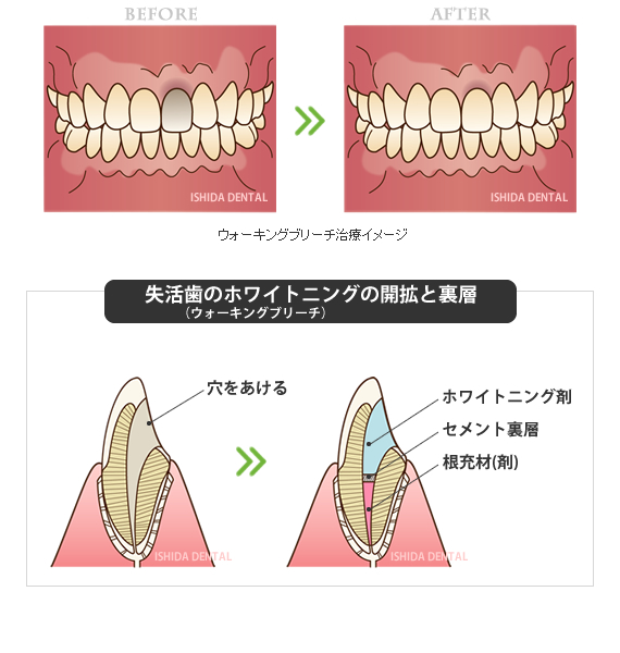 ウォーキングブリーチ　イメージ